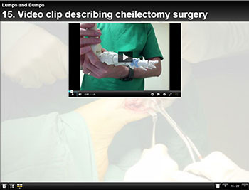 Video clip describing cheilectomy surgery